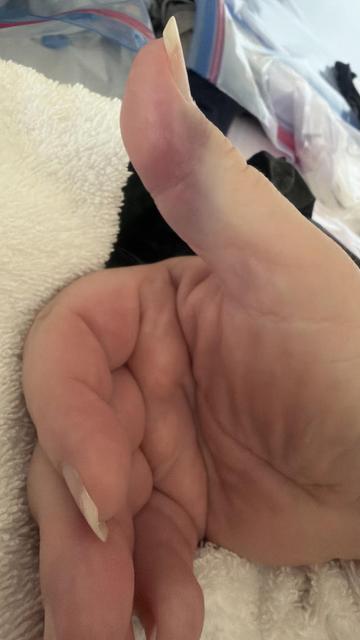 A close-up view of a hand displaying a palm and thumb. The thumb is extended, and the nails appear long and unpolished. The hand is resting on a white towel with a blurred background featuring various items. The thumb is black and blue.